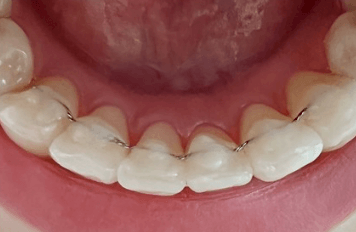 치아-교정-고정식-유지장치