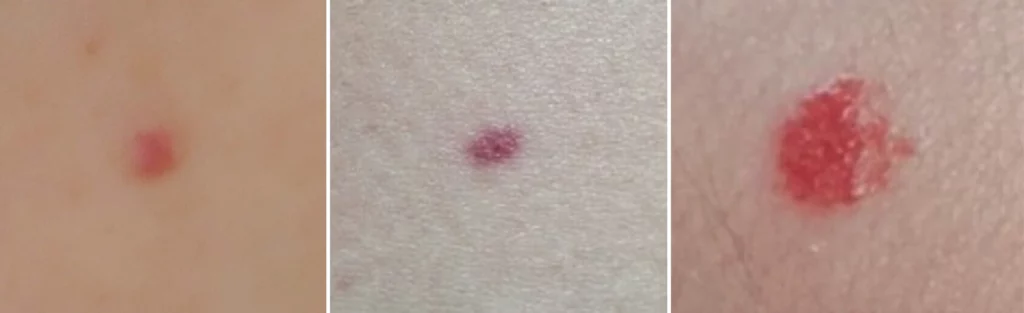 몸에 생기는 붉은점 혈관종